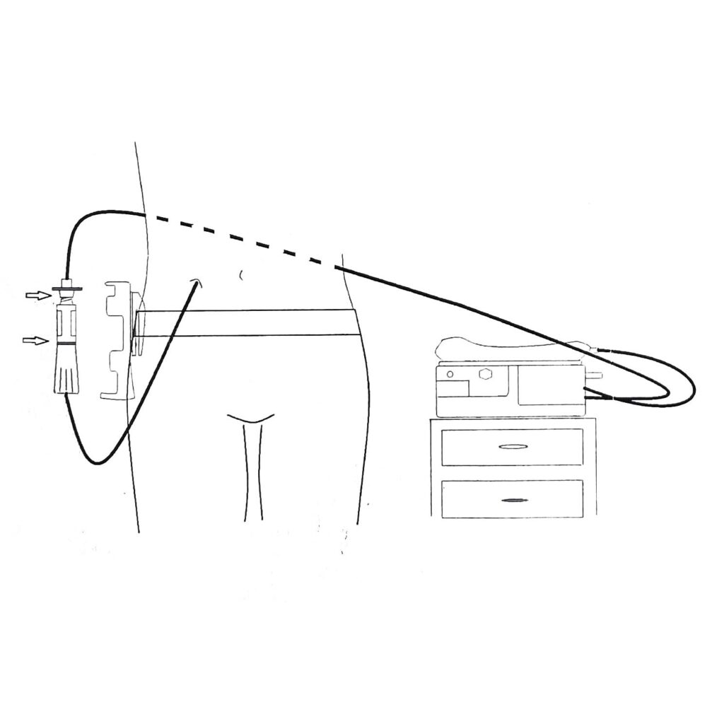 SecureWay Peritoneal Dialysis Catheter Holder Instructions Step 7